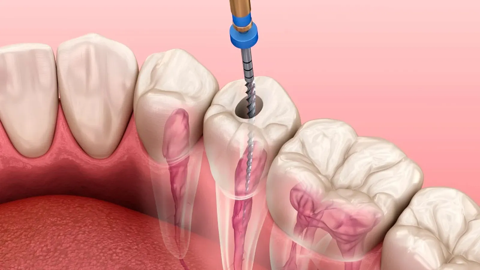 Endodontie tratament de canal NewOrtoSmile Brasov