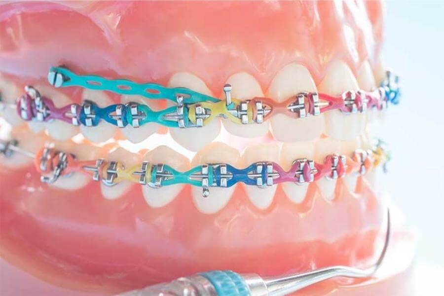 Ortodontie aparat dentar NewOrtoSmile Brasov si Fagaras