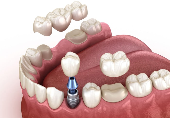 Protetica dentara coroane punti NewOrtoSmile Brasov